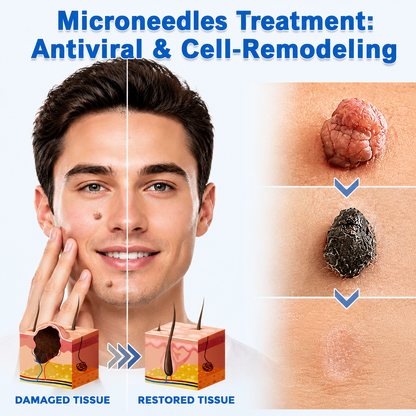 🔥 Curalona®2-in-1 Microneedle & Hydrocolloid Patch🔥| Removes Raised Moles, Acne, Flat Warts & Skin Tags | Helps Improve Wrinkles, Scars & Blemishes | Invisible Patches for Face & Body
