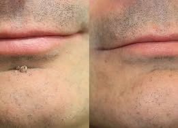🔥 Curalona®2-in-1 Microneedle & Hydrocolloid Patch🔥| Removes Raised Moles, Acne, Flat Warts & Skin Tags | Helps Improve Wrinkles, Scars & Blemishes | Invisible Patches for Face & Body