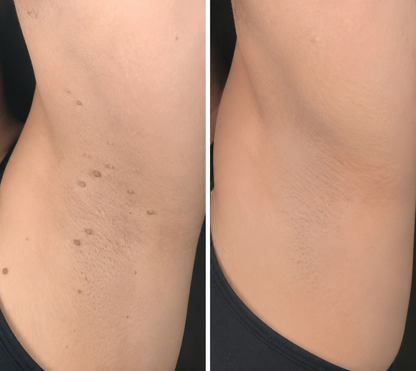 🔥 Curalona®2-in-1 Microneedle & Hydrocolloid Patch🔥| Removes Raised Moles, Acne, Flat Warts & Skin Tags | Helps Improve Wrinkles, Scars & Blemishes | Invisible Patches for Face & Body