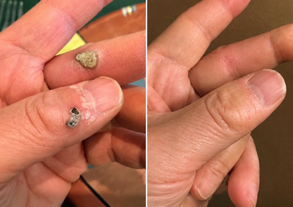 🔥 Curalona®2-in-1 Microneedle & Hydrocolloid Patch🔥| Removes Raised Moles, Acne, Flat Warts & Skin Tags | Helps Improve Wrinkles, Scars & Blemishes | Invisible Patches for Face & Body